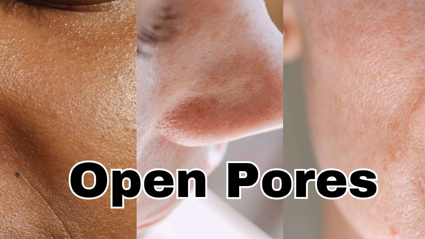 how to get rid of enlarged pores on face naturally